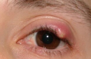 White pimple on eyelid or upper eyelid
