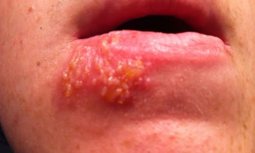 Cluster of small blisters on lip - second stage of a cold sore