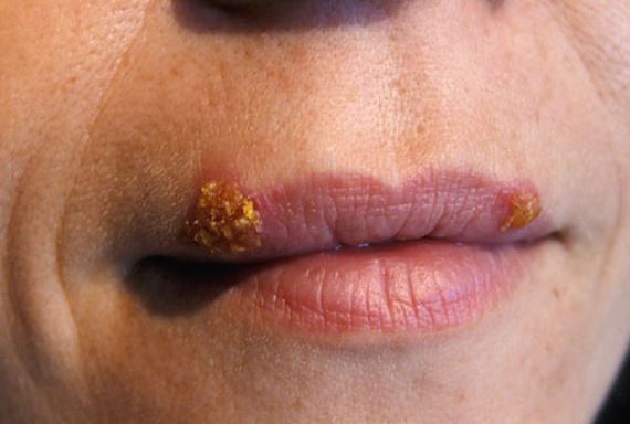 Cold sore stages - crusting or scabbing