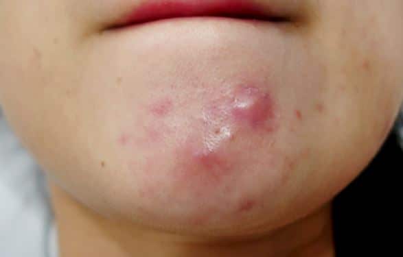 Deep cystic pimples on chin