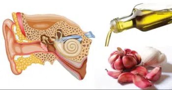 Garlic oil for ear infection treatment and unclogging clogged ears