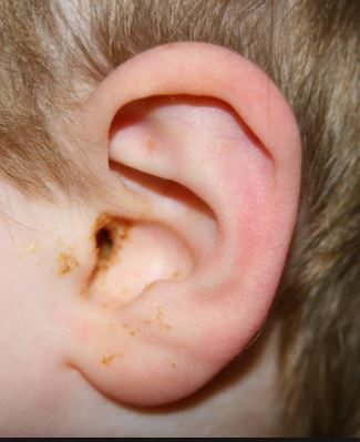 Signs of ear infection and how to make garlic oil to treat ear infections fast