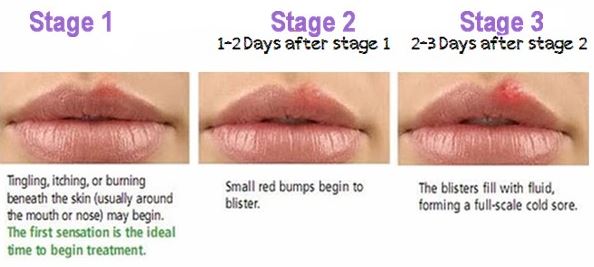 Stages of a cold sore Women's Health Advice
