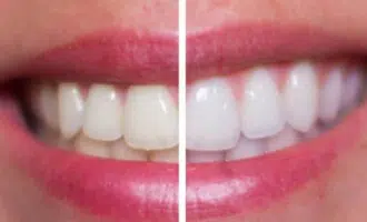 Gargling with hydrogen peroxide for teeth whitening and infections