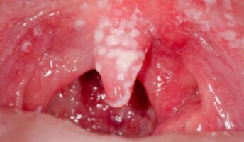 White patches in mouth from oral thrush