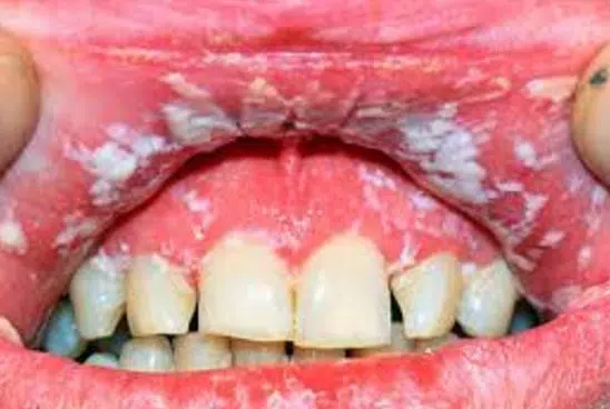 candidiasis-or-oral-thrush-can-also-cause-white-patches-and-spots-on-the-gums