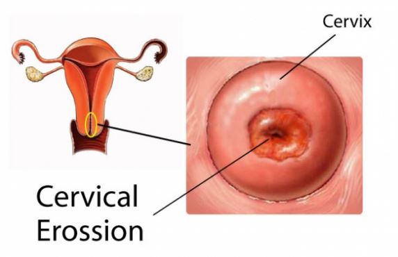 Cervical erosion, vaginal erosion or cervical ectropion