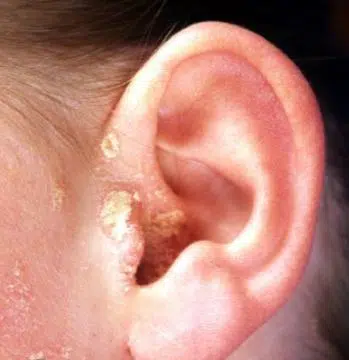 Crusty ears due to dry skin