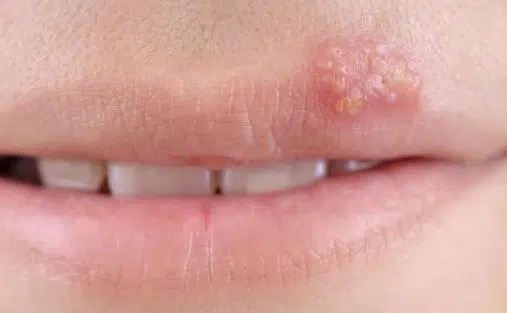 Herpes sore on lips not fordyce spots