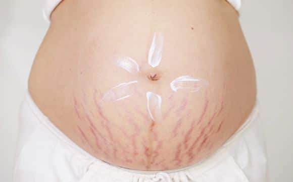 How to prevent stretch marks during pregnancy and when losing weight