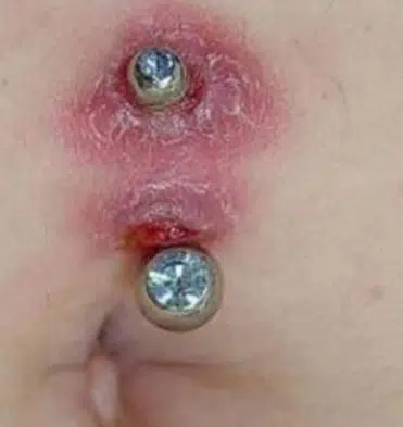 Infected navel piercing can turn itchy