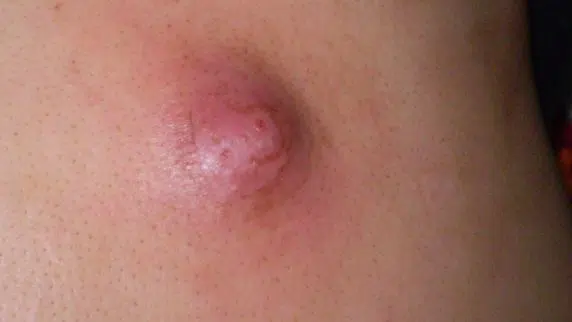 Lump on sweat glands due to infection
