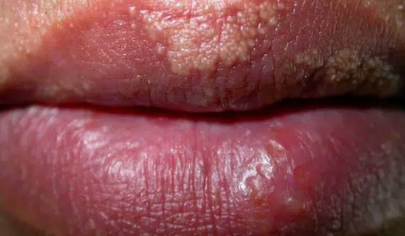 Pictures of fordyce granules on lips