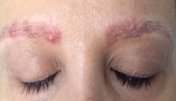 pimples-on-the-eyebrows-may-become-itchy-and-inflamed