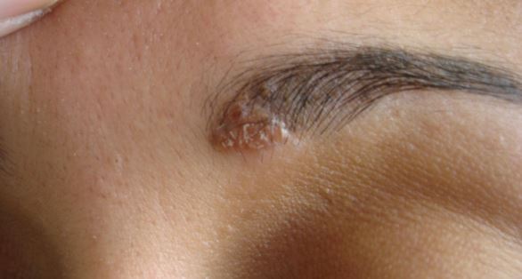 Dry Patch On Eyebrow