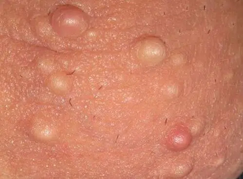 Rash on testicles or rash on scrotum balls