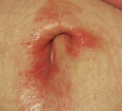Itchy red rash around belly button