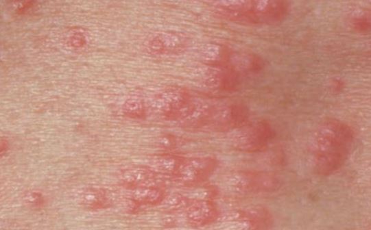 STD rash on scrotum pictures