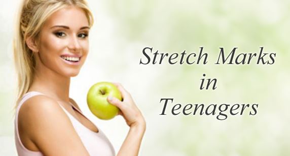 Stretch marks are also common in teenagers and appear as silver stripes