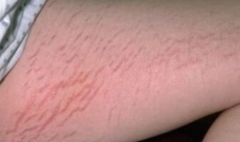 stretch-marks-on-legs-and-upper-thighs