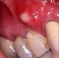 White Spots on Gums, on Baby, Painful Small White Bumps, Patches, Dots ...