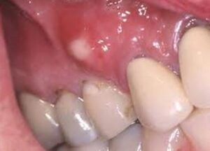 White Spots On Gums On Baby Painful Small White Bumps Patches Dots   White Spots On Gums 300x216 