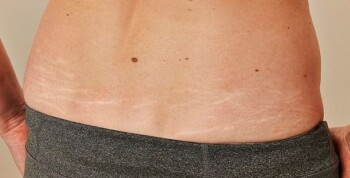 White stretch marks on back or lower back