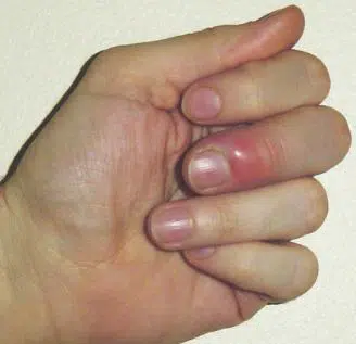 infected-thumb-swelling