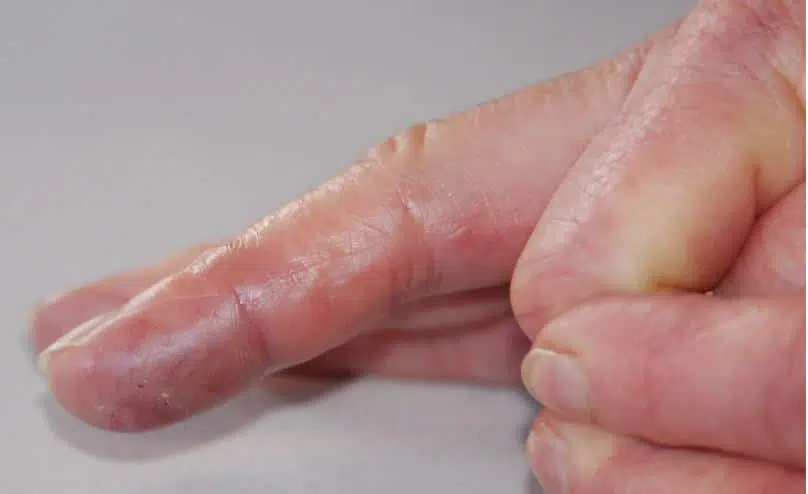 Small itchy bumps on fingers may be due to allergic reactions