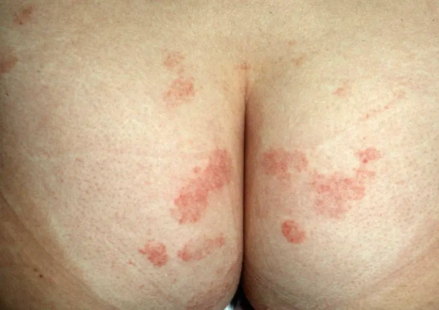 rash-on-buttocks