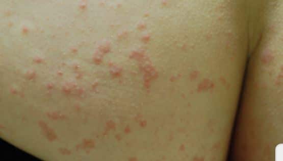 Red rash on buttocks from fungal infections