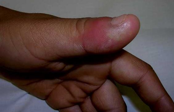 Swollen thumb causes and treatment