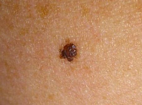 a-black-lumpy-spot-on-breast-could-be-a-sign-of-cancer
