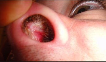 An irritated itchy inside nose or nasal lining