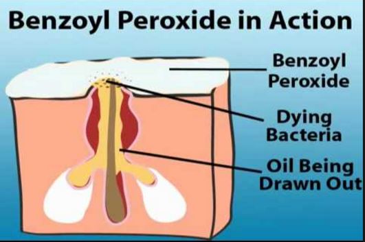 Benzoyl peroxide home remedy for blind pimples
