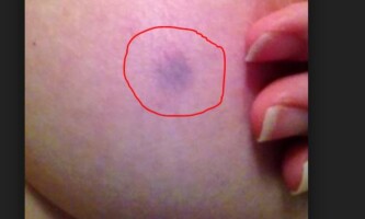 Black spots on nipples and breast area