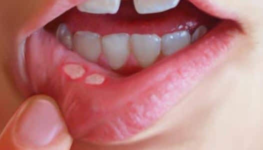 Canker sores in mouth
