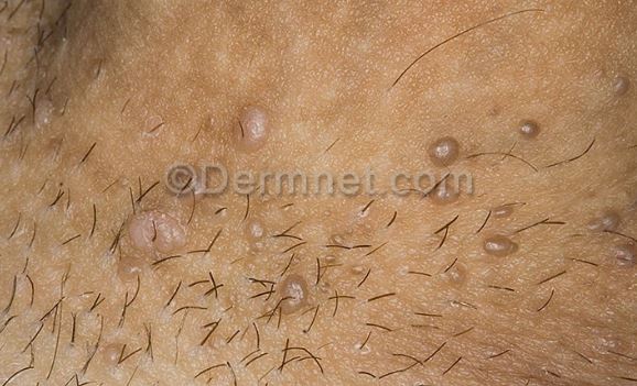 Genital warts can cause black circular spots on penis and genital area