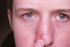 how-to-get-rid-of-a-blind-pimple-fast