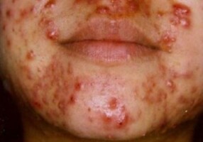 nodular acne