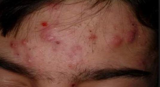 nodular-acne-zits-on-forehead