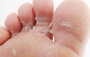 Peeling skin on feet and toes fungal infection