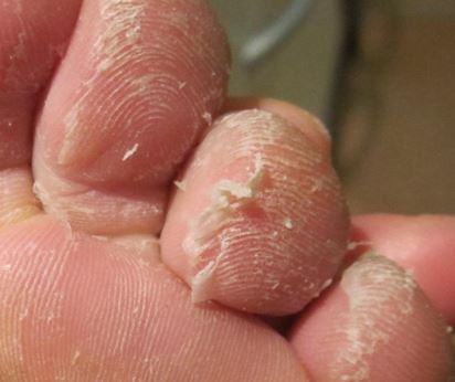 peeling-skin-on-feet-and-toes