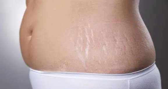 Pregnancy can leave you with white stretch marks