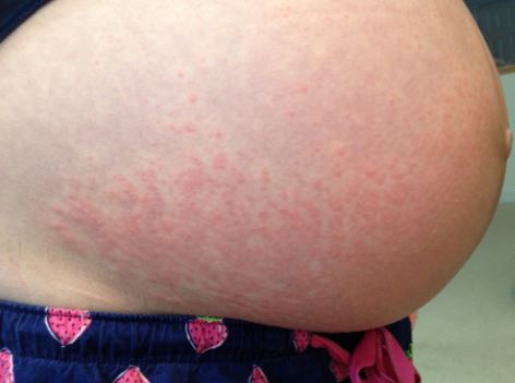 stomach-rash-during-pregnancy