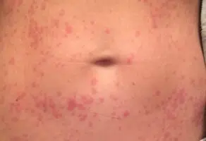 Rash on stomach red, itchy, lower, side of belly and back