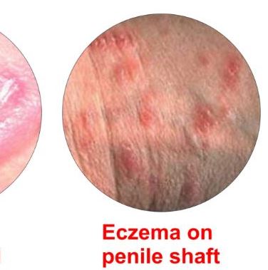 Itchy penis skin from eczema, psoriasis.