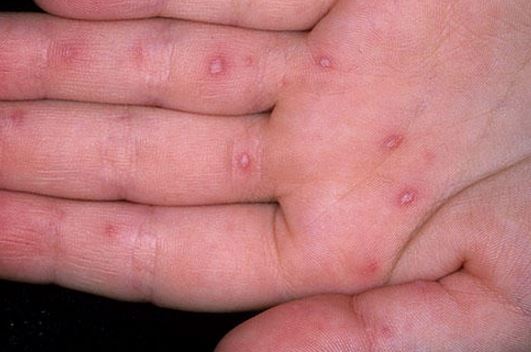 Bumps on palms may cause itching.