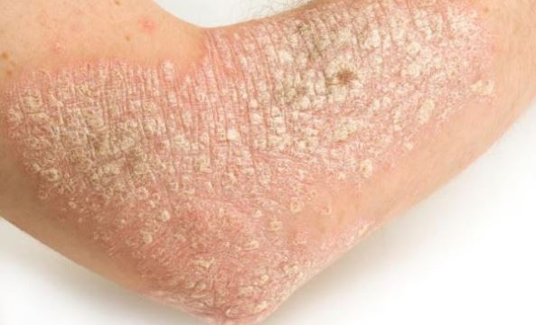 Dry skin on elbows can lead to itching
