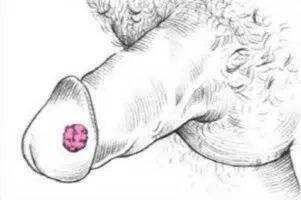 Early symptoms of penile cancer